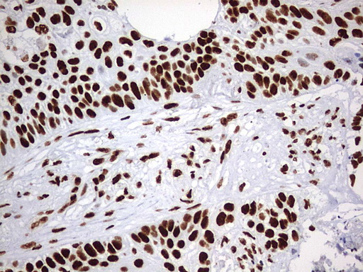 HNRPM / HNRNPM Antibody - IHC of paraffin-embedded Carcinoma of Human lung tissue using anti-HNRNPM mouse monoclonal antibody. (Heat-induced epitope retrieval by 1 mM EDTA in 10mM Tris, pH9.0, 120°C for 3min).