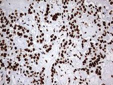 HNRPM / HNRNPM Antibody - IHC of paraffin-embedded Carcinoma of Human pancreas tissue using anti-HNRNPM mouse monoclonal antibody. (Heat-induced epitope retrieval by 1 mM EDTA in 10mM Tris, pH9.0, 120°C for 3min).