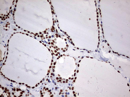 HNRPM / HNRNPM Antibody - IHC of paraffin-embedded Human thyroid tissue using anti-HNRNPM mouse monoclonal antibody. (Heat-induced epitope retrieval by 1 mM EDTA in 10mM Tris, pH9.0, 120°C for 3min).