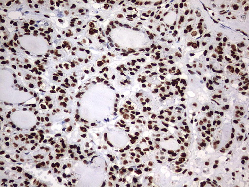 HNRPM / HNRNPM Antibody - IHC of paraffin-embedded Carcinoma of Human thyroid tissue using anti-HNRNPM mouse monoclonal antibody. (Heat-induced epitope retrieval by 1 mM EDTA in 10mM Tris, pH9.0, 120°C for 3min).