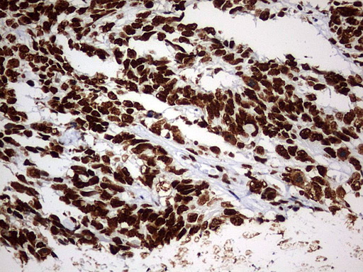 HNRPM / HNRNPM Antibody - IHC of paraffin-embedded Adenocarcinoma of Human endometrium tissue using anti-HNRNPM mouse monoclonal antibody. (Heat-induced epitope retrieval by 1 mM EDTA in 10mM Tris, pH9.0, 120°C for 3min).