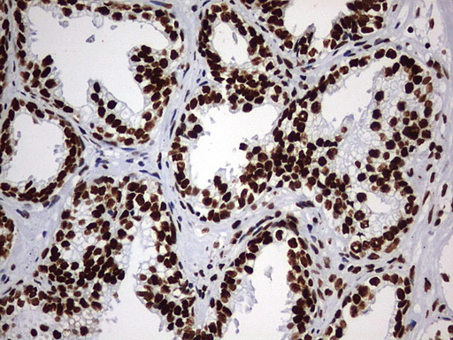 HNRPM / HNRNPM Antibody - IHC of paraffin-embedded Carcinoma of Human prostate tissue using anti-HNRNPM mouse monoclonal antibody. (Heat-induced epitope retrieval by 1 mM EDTA in 10mM Tris, pH9.0, 120°C for 3min).