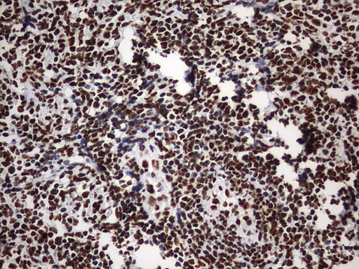 HNRPM / HNRNPM Antibody - IHC of paraffin-embedded Human lymphoma tissue using anti-HNRNPM mouse monoclonal antibody. (Heat-induced epitope retrieval by 1 mM EDTA in 10mM Tris, pH9.0, 120°C for 3min).