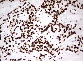 HNRPM / HNRNPM Antibody - IHC of paraffin-embedded Carcinoma of Human pancreas tissue using anti-HNRNPM mouse monoclonal antibody. (Heat-induced epitope retrieval by 10mM citric buffer, pH6.0, 120°C for 3min).