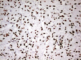 HNRPM / HNRNPM Antibody - IHC of paraffin-embedded Carcinoma of Human prostate tissue using anti-HNRNPM mouse monoclonal antibody. (Heat-induced epitope retrieval by 10mM citric buffer, pH6.0, 120°C for 3min).