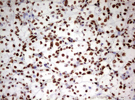 HNRPM / HNRNPM Antibody - IHC of paraffin-embedded Carcinoma of Human kidney tissue using anti-HNRNPM mouse monoclonal antibody. (Heat-induced epitope retrieval by 10mM citric buffer, pH6.0, 120°C for 3min).