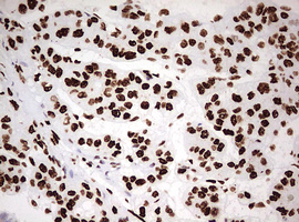 HNRPM / HNRNPM Antibody - IHC of paraffin-embedded Carcinoma of Human liver tissue using anti-HNRNPM mouse monoclonal antibody. (Heat-induced epitope retrieval by 10mM citric buffer, pH6.0, 120°C for 3min).