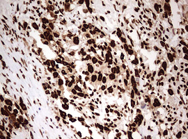 HNRPM / HNRNPM Antibody - IHC of paraffin-embedded Adenocarcinoma of Human ovary tissue using anti-HNRNPM mouse monoclonal antibody. (Heat-induced epitope retrieval by 10mM citric buffer, pH6.0, 120°C for 3min).