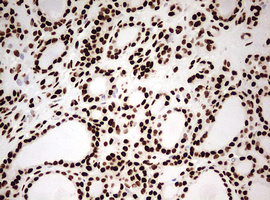 HNRPM / HNRNPM Antibody - IHC of paraffin-embedded Carcinoma of Human thyroid tissue using anti-HNRNPM mouse monoclonal antibody. (Heat-induced epitope retrieval by 10mM citric buffer, pH6.0, 120°C for 3min).