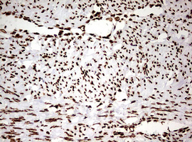 HNRPM / HNRNPM Antibody - IHC of paraffin-embedded Adenocarcinoma of Human endometrium tissue using anti-HNRNPM mouse monoclonal antibody. (Heat-induced epitope retrieval by 10mM citric buffer, pH6.0, 120°C for 3min).