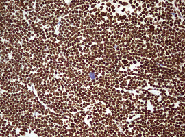 HNRPM / HNRNPM Antibody - IHC of paraffin-embedded Human lymphoma tissue using anti-HNRNPM mouse monoclonal antibody. (Heat-induced epitope retrieval by 10mM citric buffer, pH6.0, 120°C for 3min).