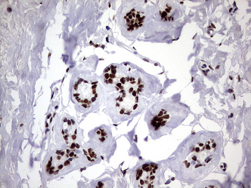HNRPM / HNRNPM Antibody - IHC of paraffin-embedded Human breast tissue using anti-HNRNPM mouse monoclonal antibody. (Heat-induced epitope retrieval by 1 mM EDTA in 10mM Tris, pH8.5, 120°C for 3min).
