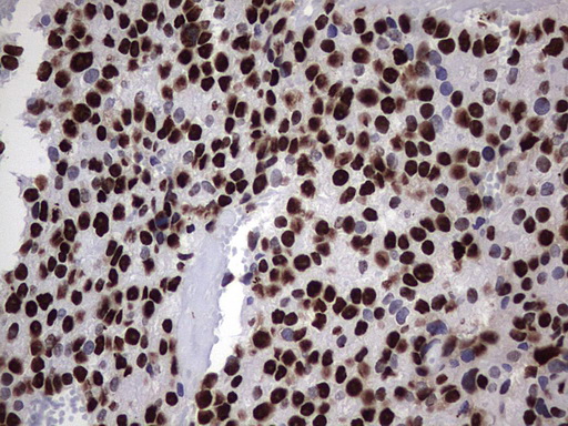 HNRPM / HNRNPM Antibody - IHC of paraffin-embedded Adenocarcinoma of Human breast tissue using anti-HNRNPM mouse monoclonal antibody. (Heat-induced epitope retrieval by 1 mM EDTA in 10mM Tris, pH8.5, 120°C for 3min).