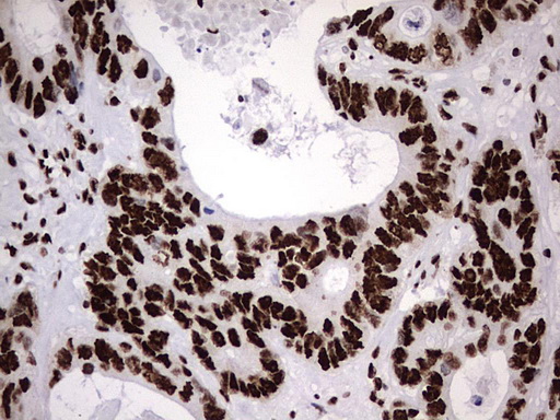 HNRPM / HNRNPM Antibody - IHC of paraffin-embedded Adenocarcinoma of Human colon tissue using anti-HNRNPM mouse monoclonal antibody. (Heat-induced epitope retrieval by 1 mM EDTA in 10mM Tris, pH8.5, 120°C for 3min).