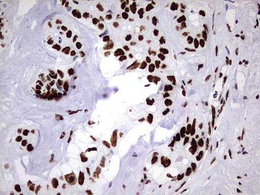 HNRPM / HNRNPM Antibody - IHC of paraffin-embedded Carcinoma of Human liver tissue using anti-HNRNPM mouse monoclonal antibody. (Heat-induced epitope retrieval by 1 mM EDTA in 10mM Tris, pH8.5, 120°C for 3min).