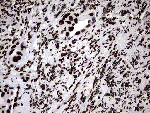 HNRPM / HNRNPM Antibody - IHC of paraffin-embedded Carcinoma of Human lung tissue using anti-HNRNPM mouse monoclonal antibody. (Heat-induced epitope retrieval by 1 mM EDTA in 10mM Tris, pH8.5, 120°C for 3min).