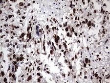 HNRPM / HNRNPM Antibody - IHC of paraffin-embedded Adenocarcinoma of Human ovary tissue using anti-HNRNPM mouse monoclonal antibody. (Heat-induced epitope retrieval by 1 mM EDTA in 10mM Tris, pH8.5, 120°C for 3min).