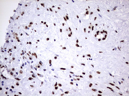HNRPM / HNRNPM Antibody - IHC of paraffin-embedded Carcinoma of Human pancreas tissue using anti-HNRNPM mouse monoclonal antibody. (Heat-induced epitope retrieval by 1 mM EDTA in 10mM Tris, pH8.5, 120°C for 3min).