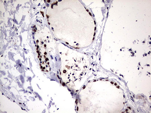 HNRPM / HNRNPM Antibody - IHC of paraffin-embedded Human thyroid tissue using anti-HNRNPM mouse monoclonal antibody. (Heat-induced epitope retrieval by 1 mM EDTA in 10mM Tris, pH8.5, 120°C for 3min).