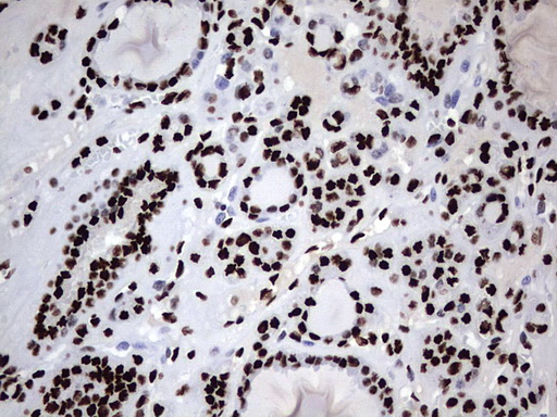 HNRPM / HNRNPM Antibody - IHC of paraffin-embedded Carcinoma of Human thyroid tissue using anti-HNRNPM mouse monoclonal antibody. (Heat-induced epitope retrieval by 1 mM EDTA in 10mM Tris, pH8.5, 120°C for 3min).