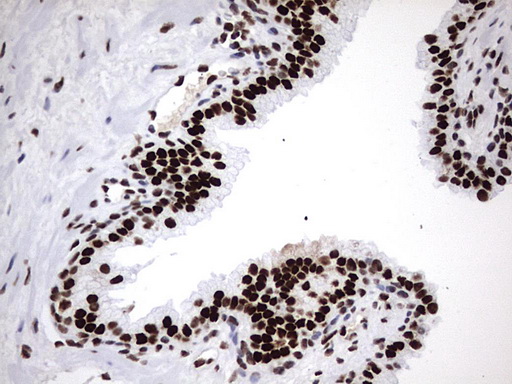 HNRPM / HNRNPM Antibody - IHC of paraffin-embedded Carcinoma of Human prostate tissue using anti-HNRNPM mouse monoclonal antibody. (Heat-induced epitope retrieval by 1 mM EDTA in 10mM Tris, pH8.5, 120°C for 3min).