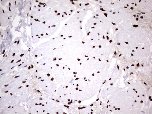 HNRPM / HNRNPM Antibody - IHC of paraffin-embedded Human bladder tissue using anti-HNRNPM mouse monoclonal antibody. (Heat-induced epitope retrieval by 1 mM EDTA in 10mM Tris, pH8.5, 120°C for 3min).