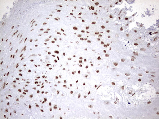 HNRPM / HNRNPM Antibody - IHC of paraffin-embedded Carcinoma of Human bladder tissue using anti-HNRNPM mouse monoclonal antibody. (Heat-induced epitope retrieval by 1 mM EDTA in 10mM Tris, pH8.5, 120°C for 3min).