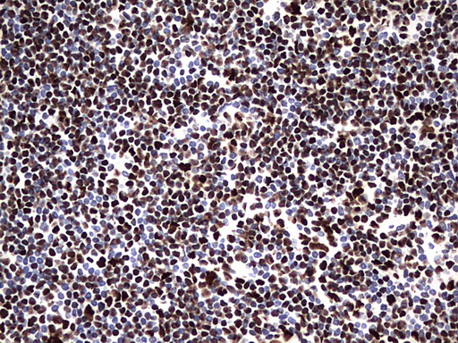 HNRPM / HNRNPM Antibody - IHC of paraffin-embedded Human lymphoma tissue using anti-HNRNPM mouse monoclonal antibody. (Heat-induced epitope retrieval by 1 mM EDTA in 10mM Tris, pH8.5, 120°C for 3min).