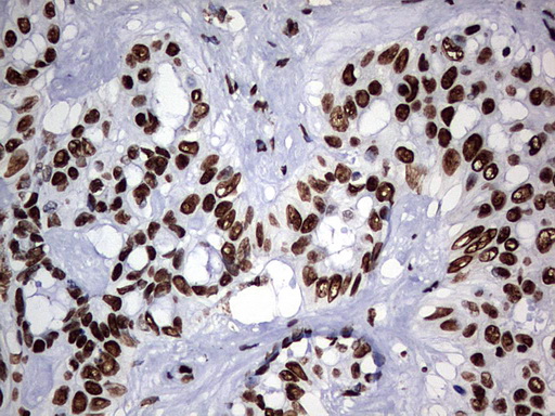 HNRPM / HNRNPM Antibody - IHC of paraffin-embedded Carcinoma of Human liver tissue using anti-HNRNPM mouse monoclonal antibody. (Heat-induced epitope retrieval by 1 mM EDTA in 10mM Tris, pH9.0, 120°C for 3min).