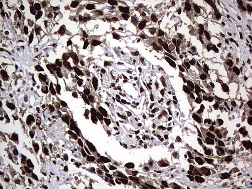 HNRPM / HNRNPM Antibody - IHC of paraffin-embedded Adenocarcinoma of Human ovary tissue using anti-HNRNPM mouse monoclonal antibody. (Heat-induced epitope retrieval by 1 mM EDTA in 10mM Tris, pH9.0, 120°C for 3min).