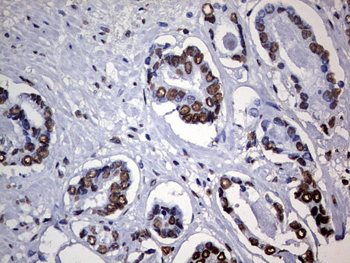 HNRPM / HNRNPM Antibody - IHC of paraffin-embedded Human prostate tissue using anti-HNRNPM mouse monoclonal antibody. (Heat-induced epitope retrieval by 1 mM EDTA in 10mM Tris, pH9.0, 120°C for 3min).