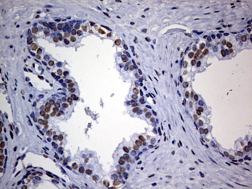 HNRPM / HNRNPM Antibody - IHC of paraffin-embedded Carcinoma of Human prostate tissue using anti-HNRNPM mouse monoclonal antibody. (Heat-induced epitope retrieval by 1 mM EDTA in 10mM Tris, pH9.0, 120°C for 3min).