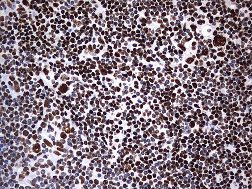 HNRPM / HNRNPM Antibody - IHC of paraffin-embedded Human lymphoma tissue using anti-HNRNPM mouse monoclonal antibody. (Heat-induced epitope retrieval by 1 mM EDTA in 10mM Tris, pH9.0, 120°C for 3min).