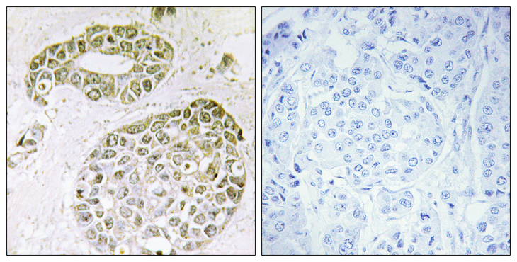 HNRPM / HNRNPM Antibody - Immunohistochemistry analysis of paraffin-embedded human breast carcinoma tissue, using hnRNP M Antibody. The picture on the right is blocked with the synthesized peptide.