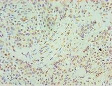 HNRPM / HNRNPM Antibody - Immunohistochemistry of paraffin-embedded human breast cancer using antibody at 1:100 dilution.