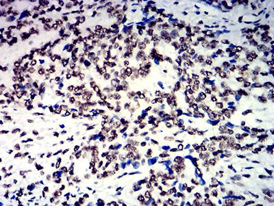 HNRPM / HNRNPM Antibody - Immunohistochemical analysis of paraffin-embedded esophageal cancer tissues using NAGR1 mouse mAb with DAB staining.