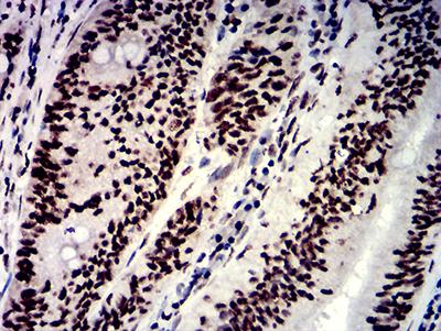 HNRPM / HNRNPM Antibody - Immunohistochemical analysis of paraffin-embedded rectum cancer tissues using NAGR1 mouse mAb with DAB staining.