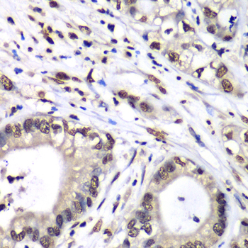 HNRPM / HNRNPM Antibody - Immunohistochemistry of paraffin-embedded human liver cancer tissue.