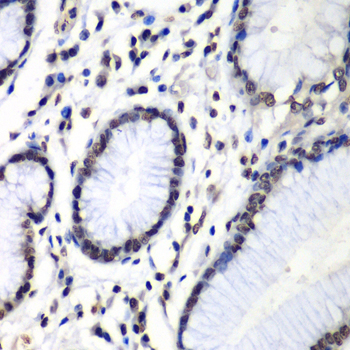 HNRPM / HNRNPM Antibody - Immunohistochemistry of paraffin-embedded human colon carcinoma tissue.