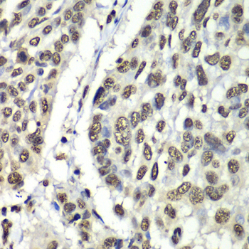 HNRPM / HNRNPM Antibody - Immunohistochemistry of paraffin-embedded human esophageal cancer tissue.