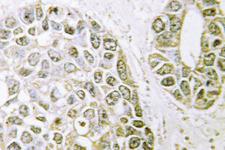 HNRPM / HNRNPM Antibody - IHC of hnRNP M (P43) pAb in paraffin-embedded human breast carcinoma tissue.