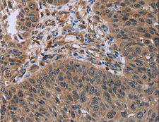 HOMER1 / Homer 1 Antibody - Immunohistochemistry of paraffin-embedded Human lung cancer using HOMER1 Polyclonal Antibody at dilution of 1:50.