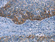HOMER1 / Homer 1 Antibody - Immunohistochemistry of paraffin-embedded Human cervical cancer using HOMER1 Polyclonal Antibody at dilution of 1:50.