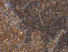 HOMER2 / Homer 2 Antibody - Immunohistochemistry of paraffin-embedded Human liver cancer using HOMER2 Polyclonal Antibody at dilution of 1:40.