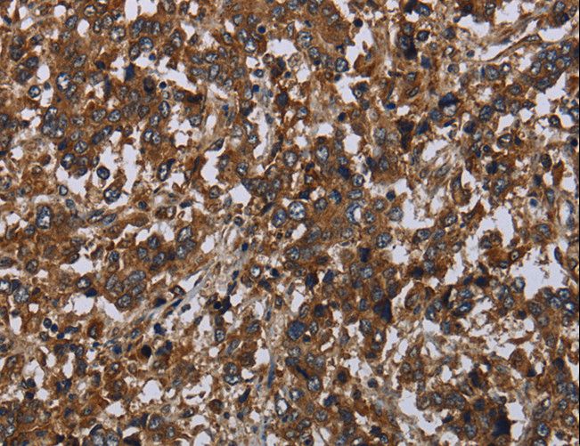 HOMER2 / Homer 2 Antibody - Immunohistochemistry of paraffin-embedded Human liver cancer using HOMER2 Polyclonal Antibody at dilution of 1:40.