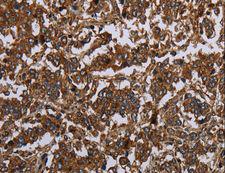 HOMER2 / Homer 2 Antibody - Immunohistochemistry of paraffin-embedded Human gastric cancer using HOMER2 Polyclonal Antibody at dilution of 1:30.