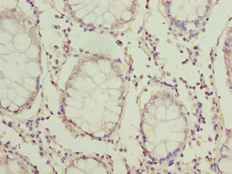 HOOK1 Antibody - Immunohistochemistry of paraffin-embedded human colon cancer using HOOK1 Antibody at dilution of 1:100