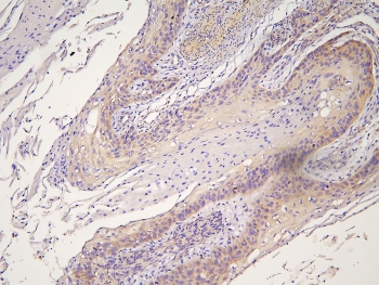 HOOK2 Antibody - IHC staining of FFPE human esophageal squamous cancer with HOOK2 antibody at 1ug/ml. HIER: boil tissue sections in pH6, 10mM citrate buffer, for 10-20 min and allow to cool before testing.