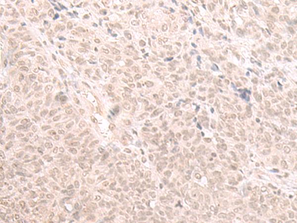 HOOK2 Antibody - Immunohistochemistry of paraffin-embedded Human ovarian cancer tissue  using HOOK2 Polyclonal Antibody at dilution of 1:30(×200)