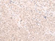 HOOK2 Antibody - Immunohistochemistry of paraffin-embedded Human ovarian cancer tissue  using HOOK2 Polyclonal Antibody at dilution of 1:30(×200)